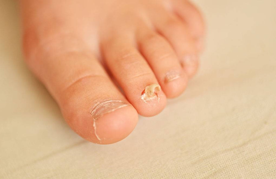 Toenail Fungus and Foot Fungal Infections